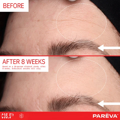 Image 1 - A before and after image shows a persons forehead, with the top half displaying wrinkles and the bottom half showing significantly smoother skin after treatment, accompanied by text that reads BEFORE, AFTER 8 WEEKS, Based on a 30-person clinical study, after 8 weeks. Individual results will vary., C35.5™, and PAREVA™. Image 2 - A before and after comparison image shows a patch of dark red and brown discoloration on a persons cheek in the BEFORE top panel, visibly faded in the AFTER 4 WEEKS bottom panel, along with the text Based on a 30-person clinical study, after 4 weeks. Individual results will vary., C35.5™, and PARËVA™. Image 3 - A red pump bottle of skincare product with a black cap is surrounded by text on a light purple background describing its ingredients: BIOACTIVE INGREDIENTS: 35.5%, MOLECUR 3™ with a hexagonal MO logo, Longevity superstar with exosomes and NAD+, 30% THD - OIL SOLUBLE VITAMIN C Tetrahexyldecyl (THD) Ascorbate is a superior form of Vitamin C thats more stable, gentle, skin-compatible and more effective, TURMERIC EXTRACT Curcumin is the active compound in turmeric (the golden spice) known as the super anti-oxidant, RESVERATROL One of the key mechanisms of longevity is by interacting with SIRT proteins, and CERAMIDES Make up 50% of the stratum corneum and are the first line of defense against inflammation & aging, while the bottle itself reads PARËVA 35.5% CHOOSE R.N SERUM SELF 10% Tetrahexyldecyl Ascorbate Brightening Booster Resveratrol Longevity Activator Turmeric Super Antioxidant 1fl.oz/30ml. Image 4 - An infographic displays a red Parēva Torch Glow Serum bottle, labeled 35.5% TORCH GLOW SERUM WITH REVITALIST™, 1 fl oz / 30 mL, 10% Tetrahexyldecyl Ascorbate, Brightening Booster, Resveratrol, Longevity Activator, Potentic Super Antioxidant, with blue lines connecting it to separate icons for Firming Oil, Antioxidant Gel, and Brightening Serum, under the heading 1 SERUM 3 PRODUCTS 35.5% BIOACTIVES and above the slogan NO FUSS. JUST RESULTS.
