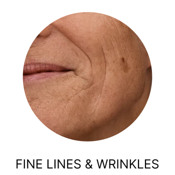 Fine lines & wrinkles