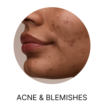 acne & blemishes